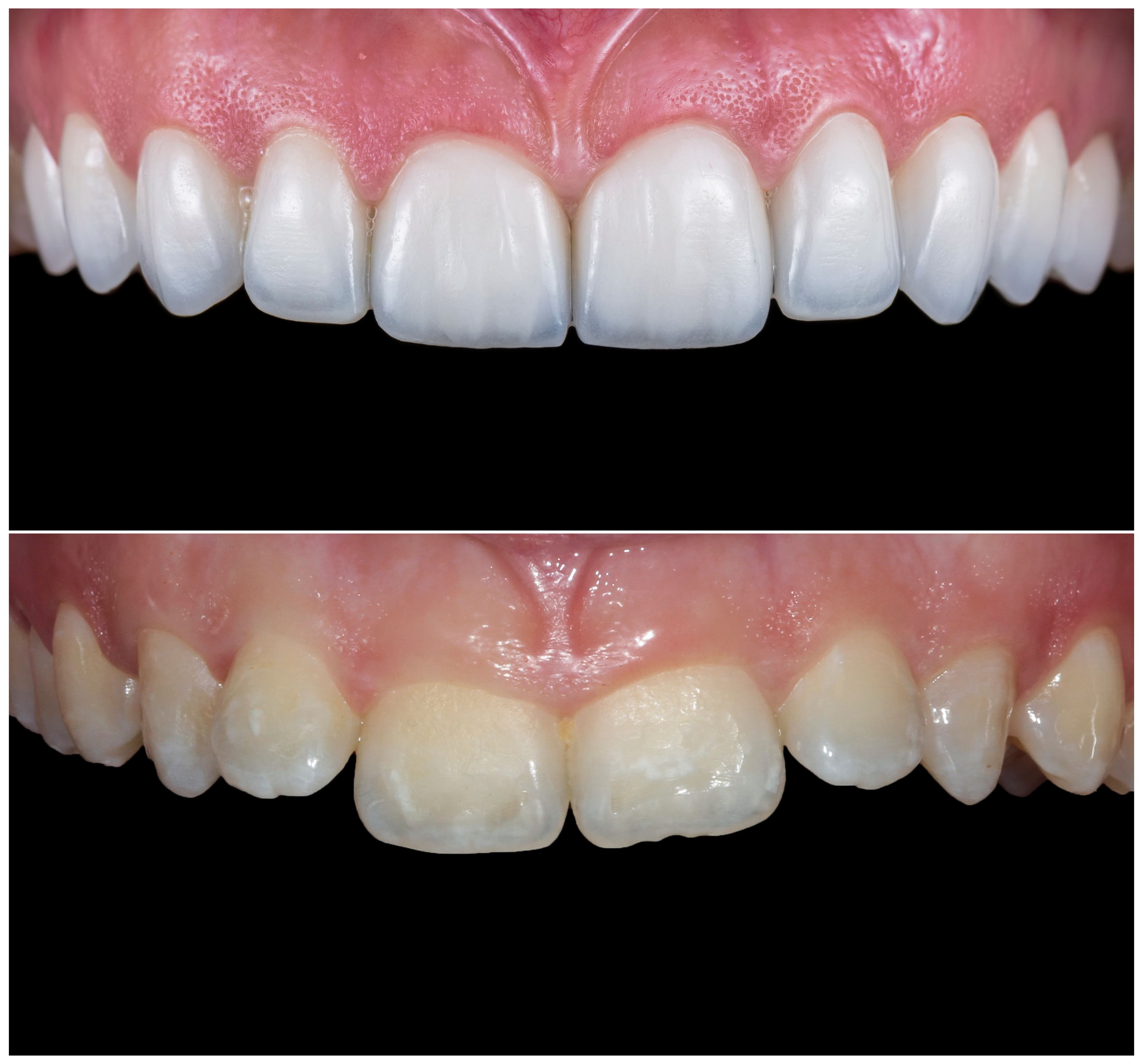 Porcelain Veneers