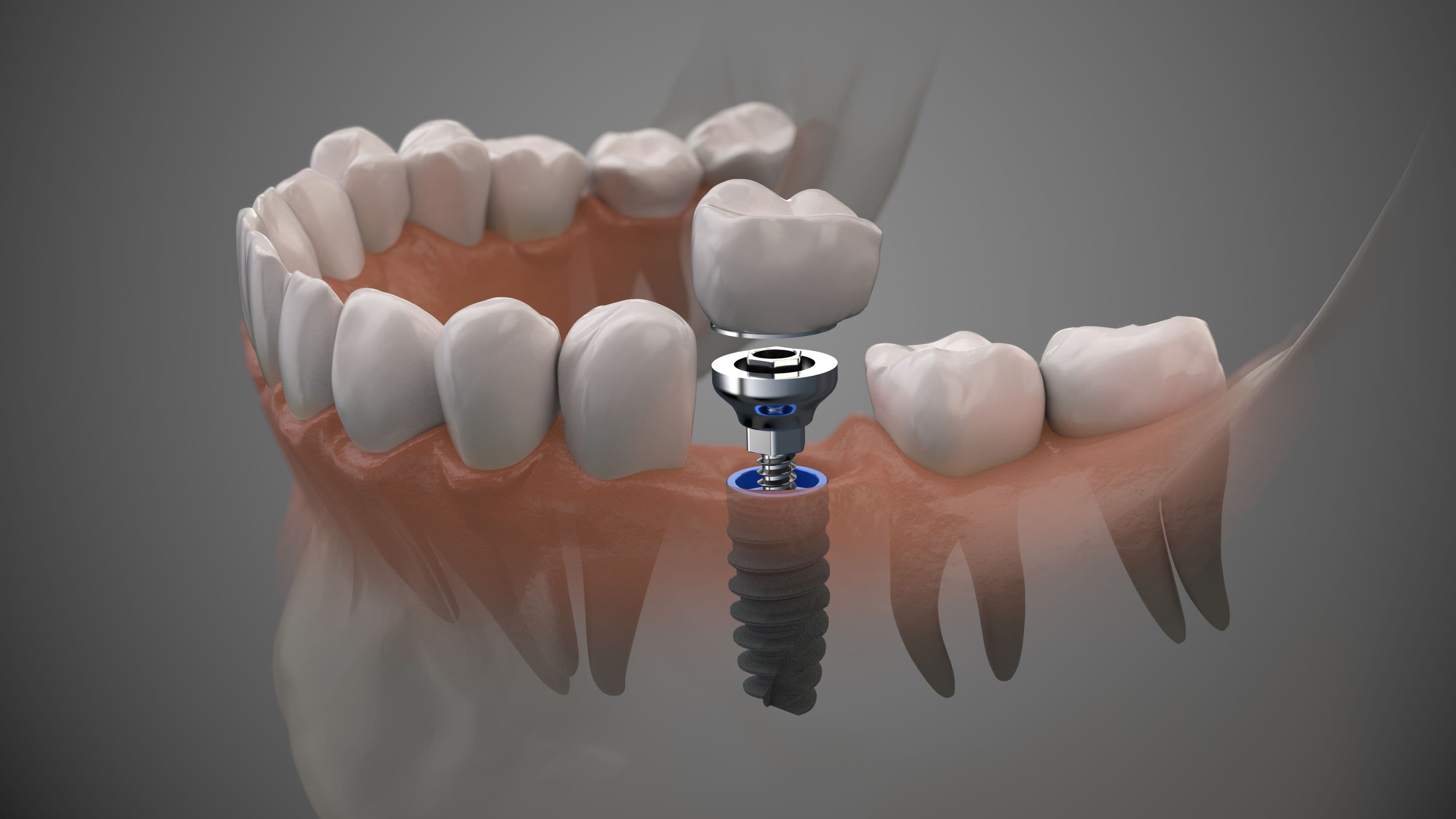 Full-Arch Implants